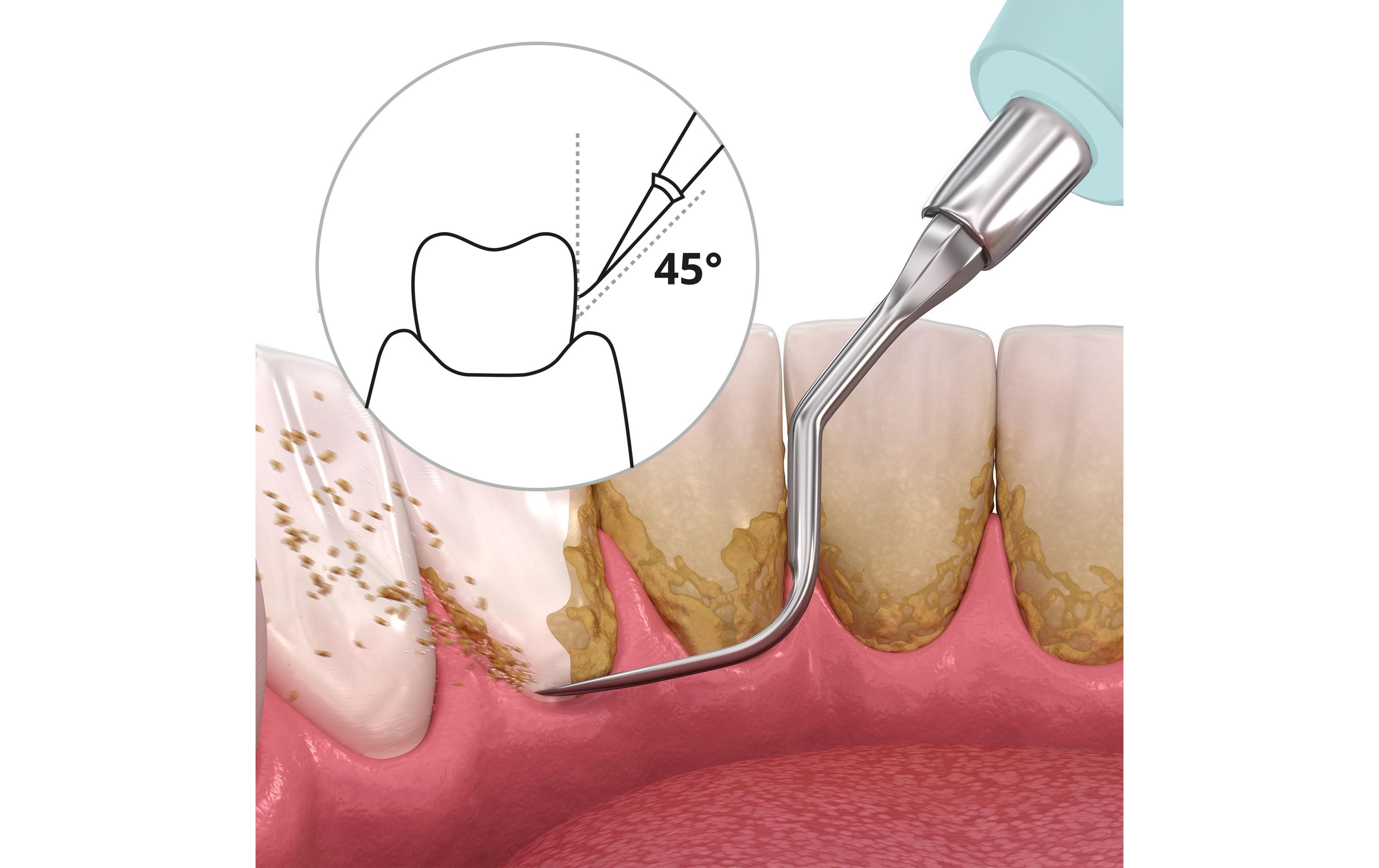 Ailoria Schall-Zahnreiniger Deplaqued Laguna